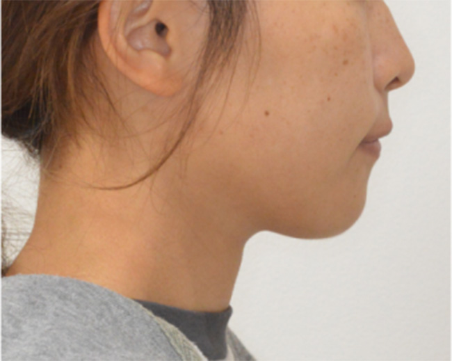 上下顎前突症例 治療終了時