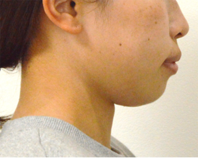 上下顎前突症例 治療開始時