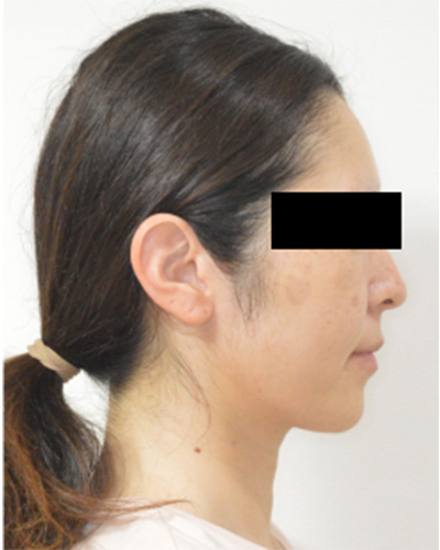 反対咬合症例 治療終了時