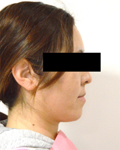 反対咬合症例 治療開始時