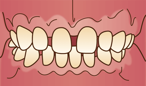 歯と歯の間の隙間がある（空隙歯列・くうげきしれつ）